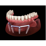 valor de prótese imediata sobre implante Vila Mariana