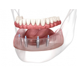 valor de prótese removível sobre implante Alameda Campinas